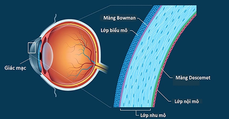 Quá trình lành vết mổ có thể thay đổi cấu trúc giác mạc gây tái cận