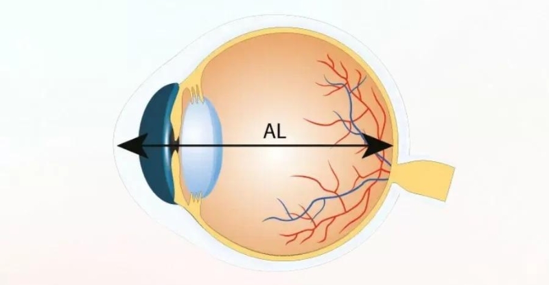 Thuốc nhỏ mắt kiểm soát cận thị Atropin giúp ức chế sự phát triển của trục nhãn cầu