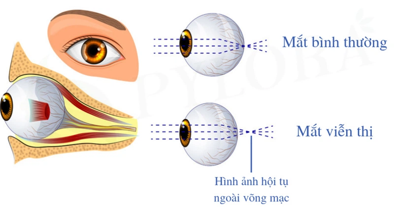 Viễn thị là một tật khúc xạ phổ biến hiện nay