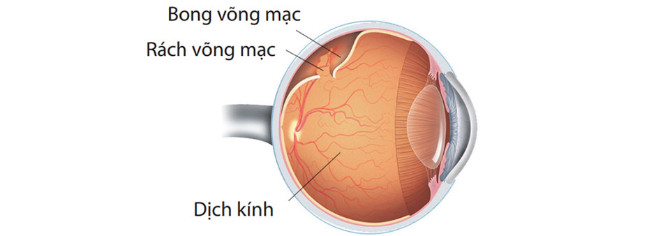 Một số yếu tố liên quan đến viễn thị có thể làm tăng nguy cơ bong võng mạc