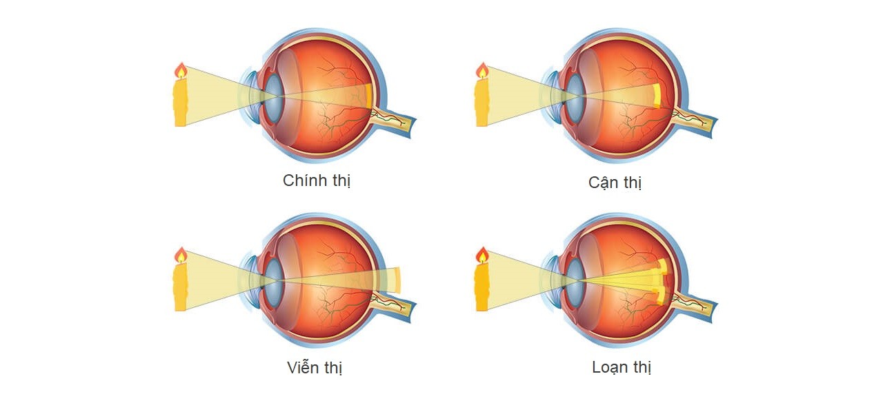 Hình ảnh nhìn thấy của mắt viễn thị và lão thị