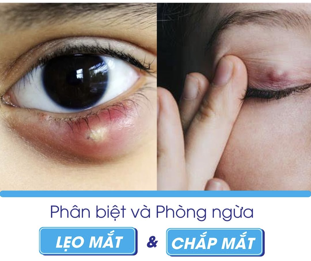 Phân biệt lẹo mắt và chắp mắt