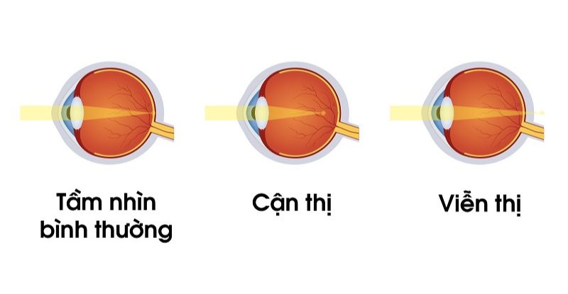 Viễn thị 12 độ có nguy hiểm không? Là câu hỏi được quan tâm bởi những người mắc viễn thị nặng