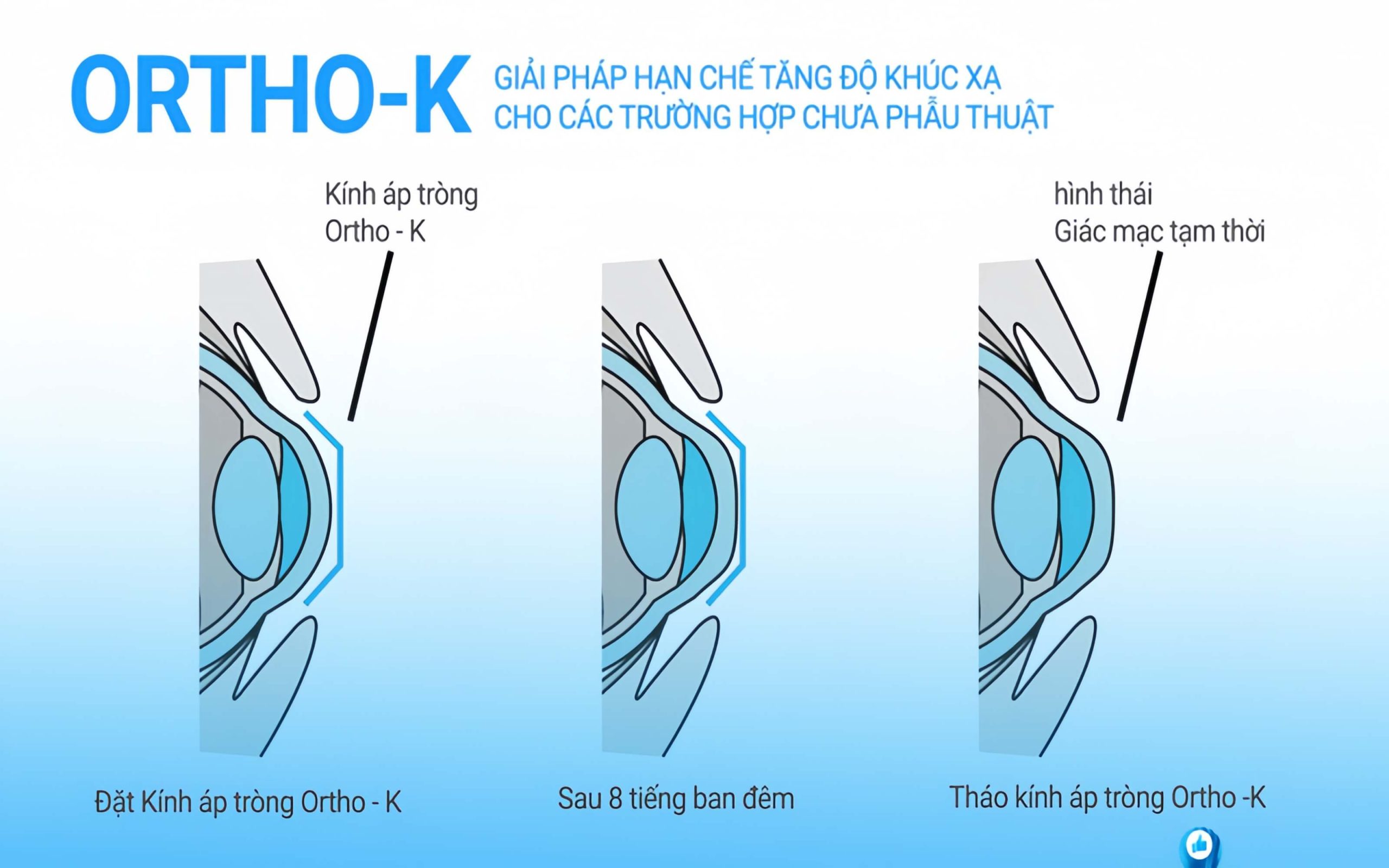 Hình dạng của giác mạc trước và sau khi đeo kính áp tròng Ortho-K