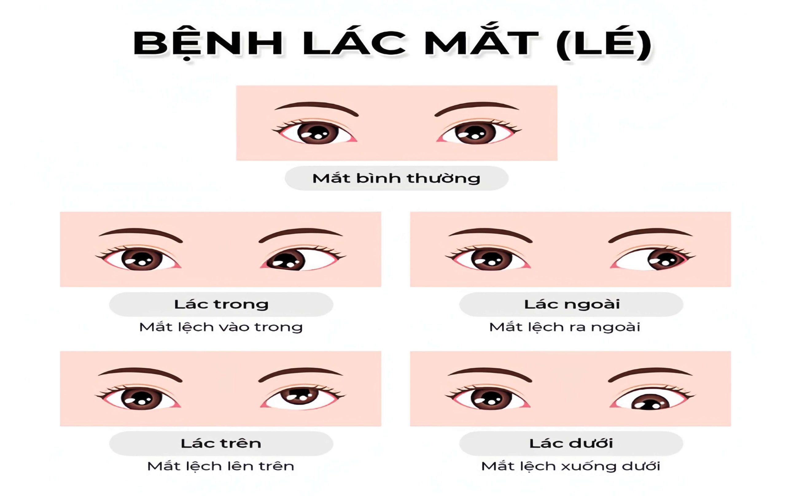 Mắt lệch theo nhiều hướng khác nhau