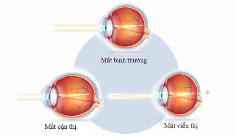 Viễn thị có thể tự khỏi không? Tìm hiểu về viễn thị