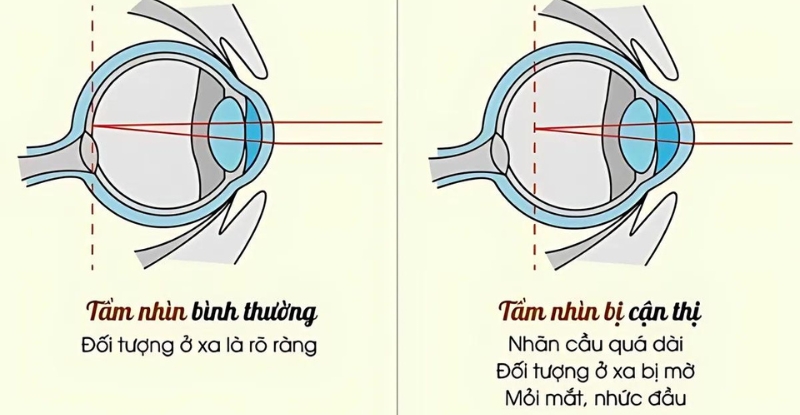 Tầm nhìn mắt bình thường và tầm nhìn mắt cận thị