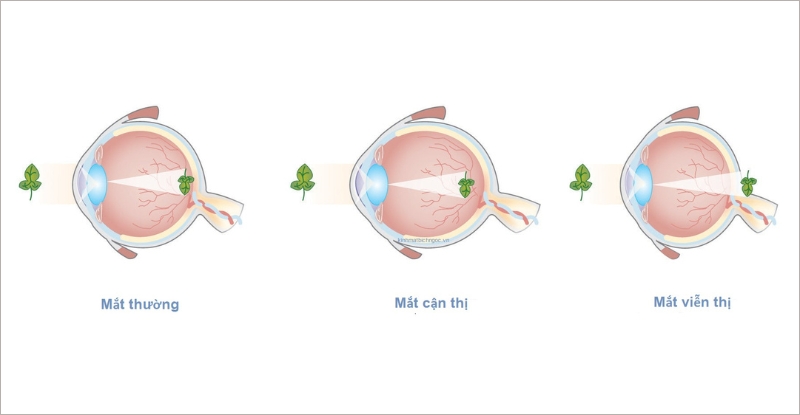 Mắt thường, mắt cận thị và mắt viễn thị