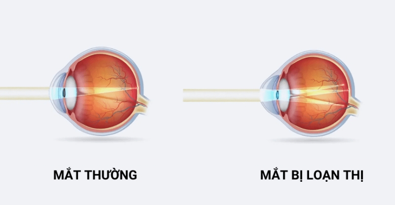 Mắt thường và mắt bị loạn thị