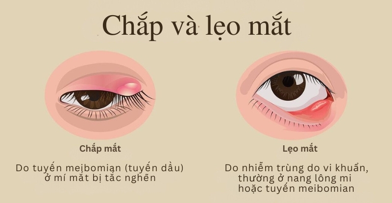 Chắp và lẹo mắt