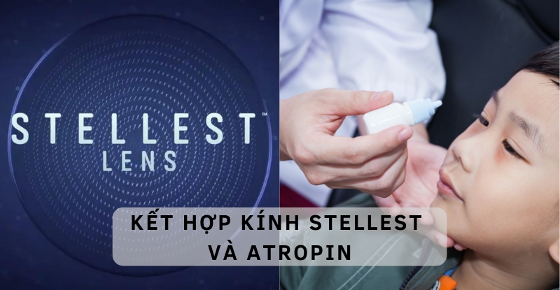 Kết hợp kính Stellest và Atropin là một phương pháp hiệu quả trong kiểm soát cận thị