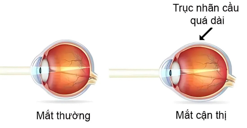 Phương pháp này giúp ổn định chiều dài trục nhãn cầu vì trục nhãn cầu quá dài là nguyên nhân chủ yếu gây cận thị