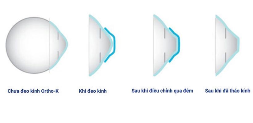 Sự thay đổi của giác mạc sau khi sử dụng kính Ortho-K.