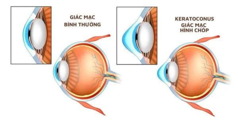 Lens cứng thường được dùng trong điều trị giác mạc chóp