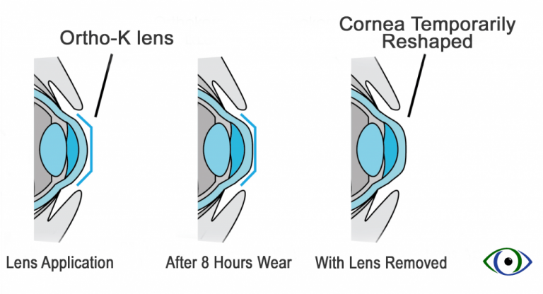 Thời gian làm quen với lens kính áp tròng Ortho-K