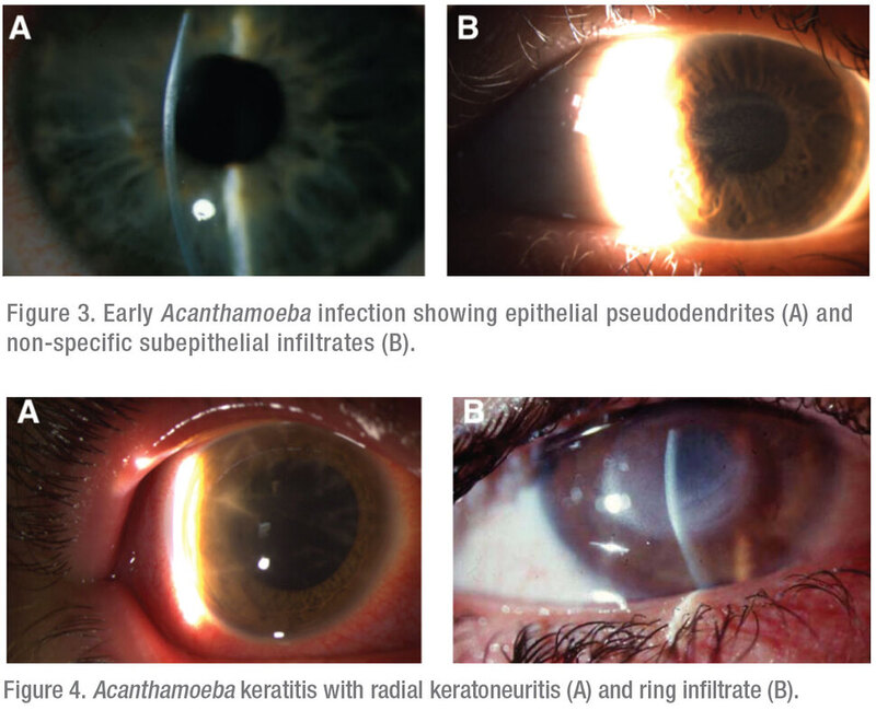 Viêm giác mạc do Acanthamoeba