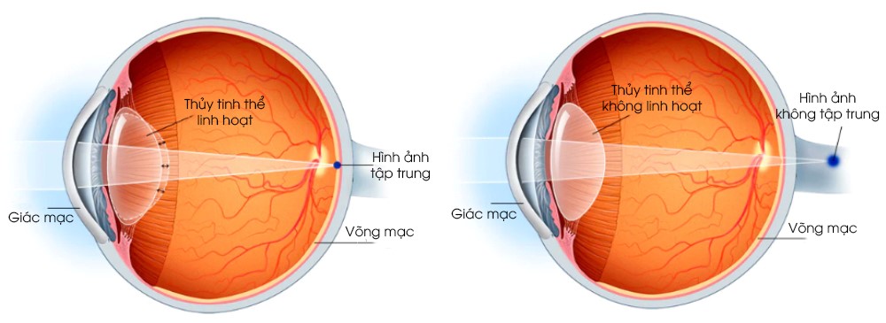 Mắt bị lão thị