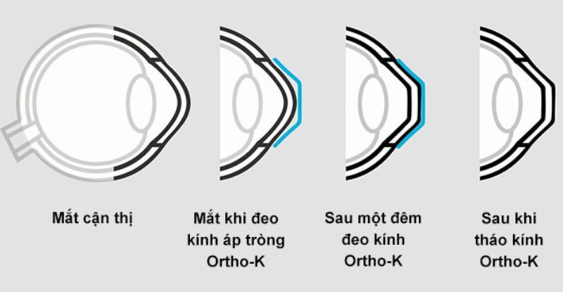 Cơ chế chỉnh hình giác mạc của kính Ortho-K