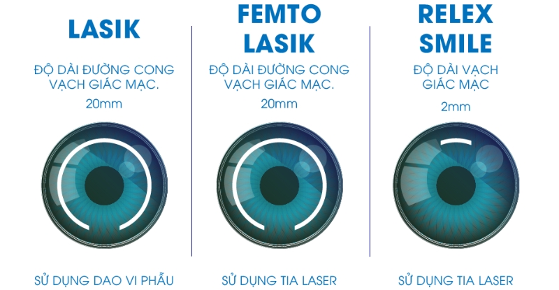 Các phương pháp phổ mổ cận Lasik thường được sử dụng