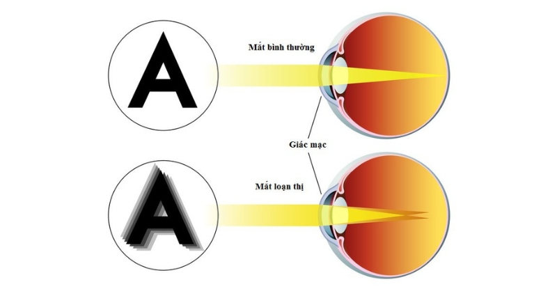 Mắt bình thường và mắt loạn thị