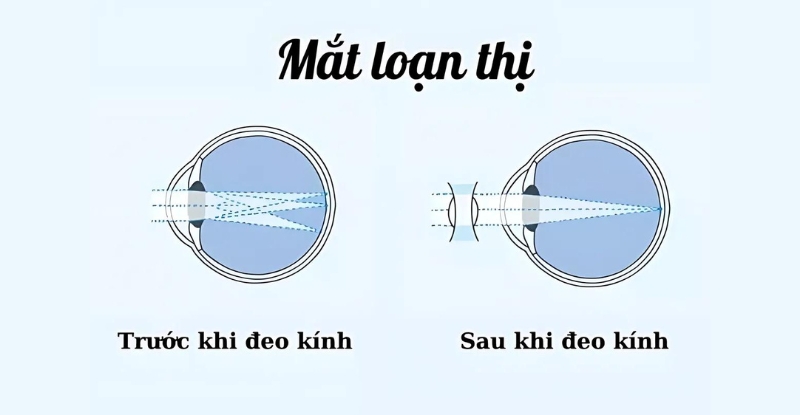 Mắt loạn thị trước và sau khi đeo kính