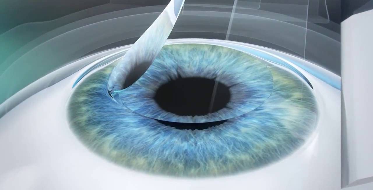 Phẫu thuật LASIK là phương pháp mổ cận phổ biến hiện nay