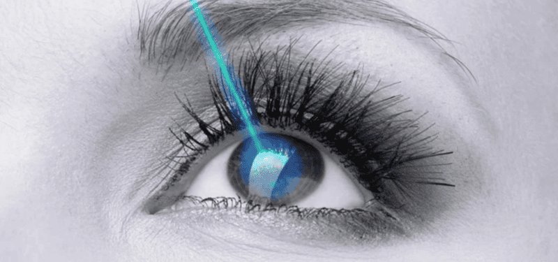 Hình ảnh minh họa phương pháp mổ Lasik