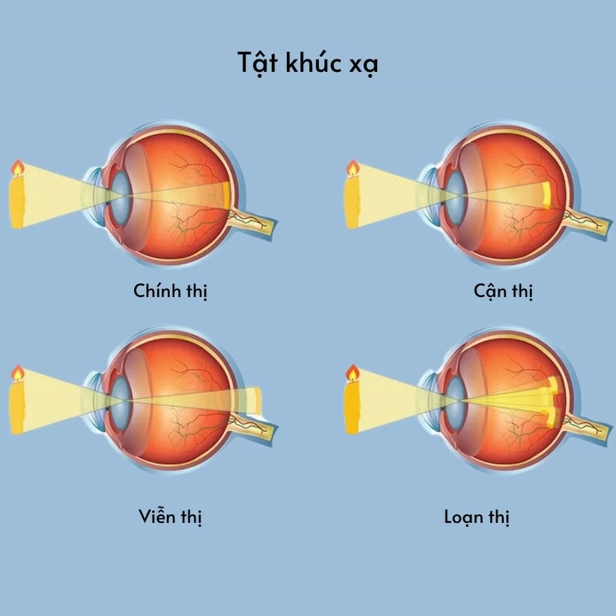 Các dạng tật khúc xạ có thể dẫn đến nhược thị