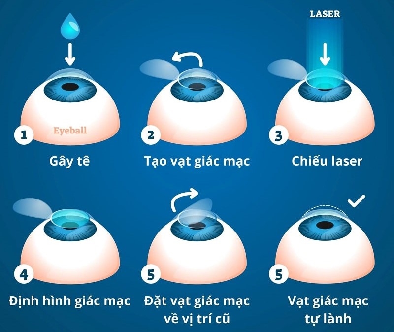 Các bước phẫu thuật mắt bằng phương pháp lasik