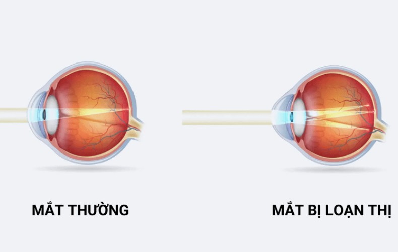 Loạn thị mắc phải là gì?