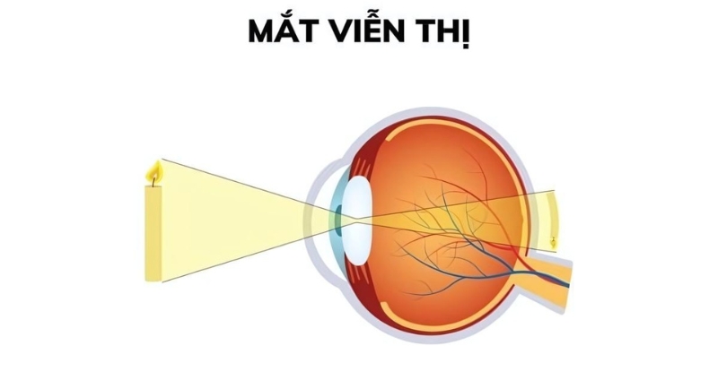 Ở mắt viễn thị, ánh sáng không hội tụ đúng tại võng mạc mà lại hội tụ phía sau võng mạc