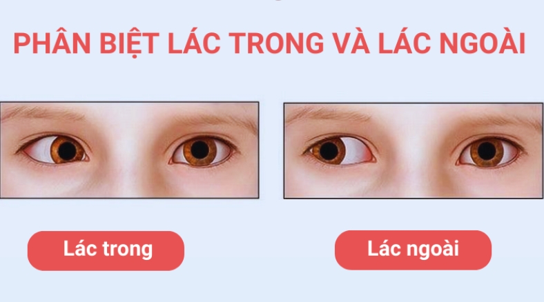 Viễn thị có thể dẫn đến cả lác trong và lác ngoài.