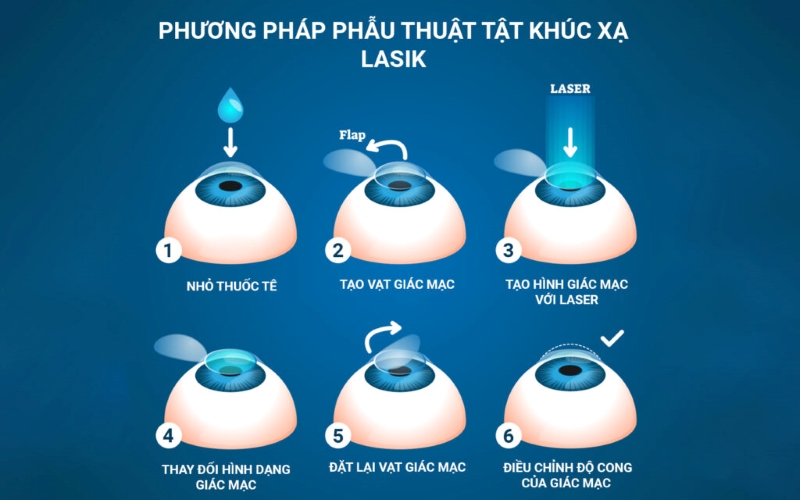 Phương pháp Lasik