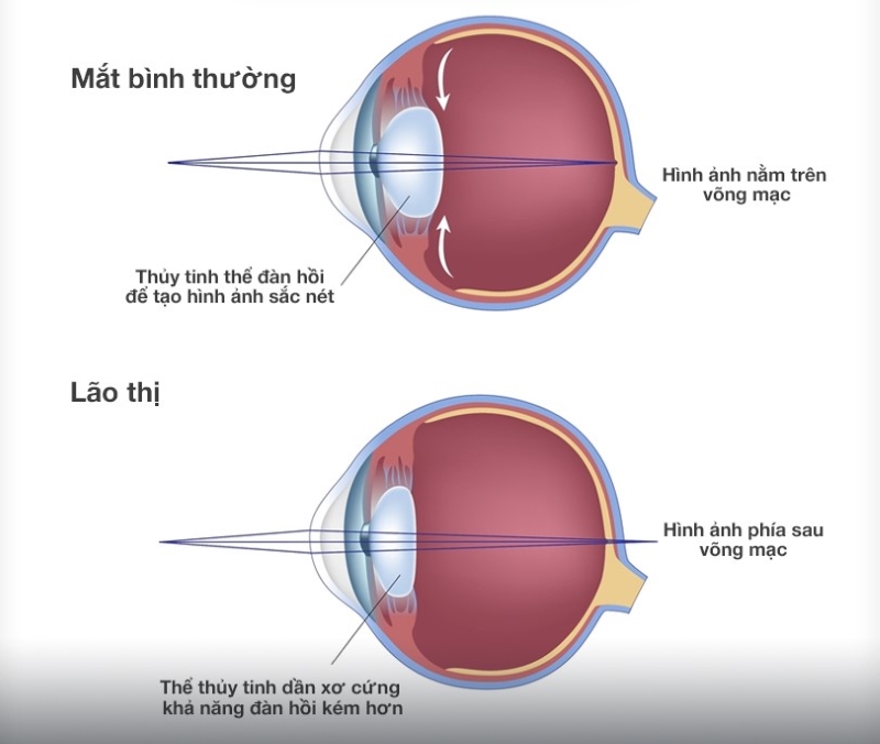 Mắt bình thường và mắt lão thị