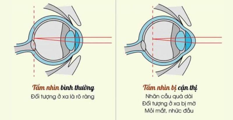 Cận thị có thể do nhiều yếu tố khác nhau gây ra và thường gặp ở trẻ em trong độ tuổi học đường