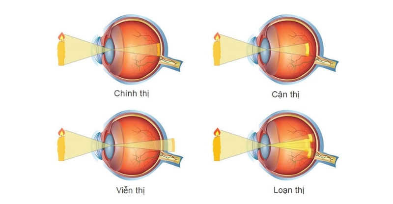 Tật khúc xạ là một trong các yếu tố nguy cơ gây nhược thị