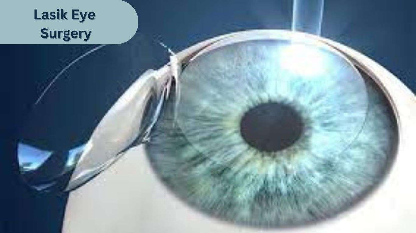 Phẫu thuật Lasik