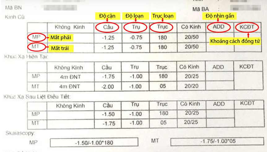 Cách hiểu thông tin về độ cận trong đơn kính