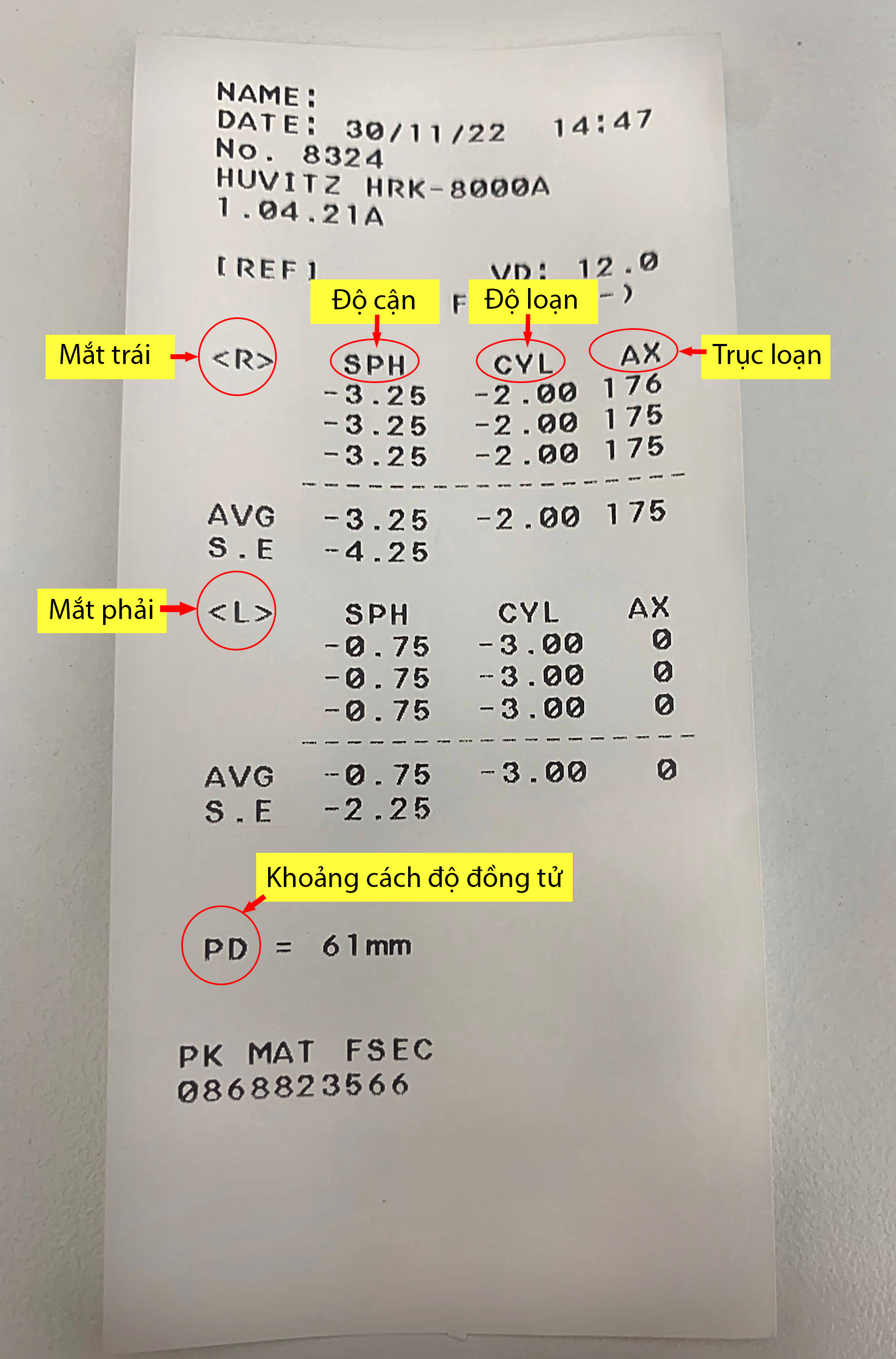 Xem kết quả độ cận từ phiếu chụp khúc xạ tự động