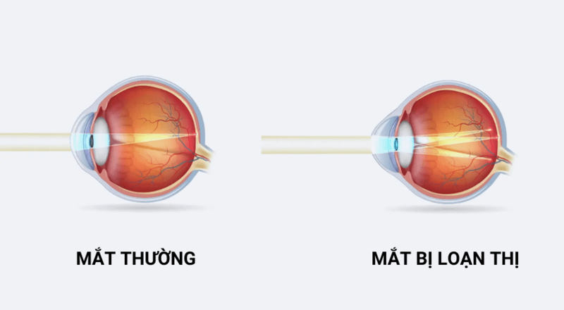 Việc hiểu về loạn thị giúp nhận biết biến chứng viêm kết mạc gây loạn thị mắc phải