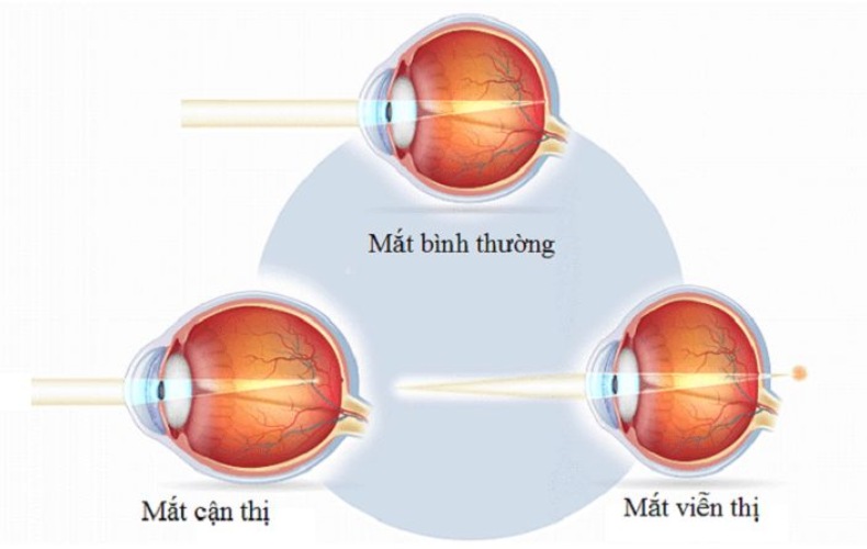 Viễn thị là gì?