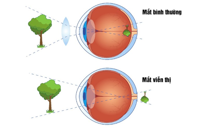 Viễn thị là gì?