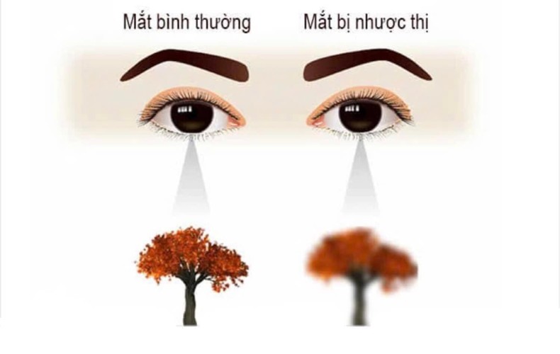 Giới thiệu về mắt nhược thị