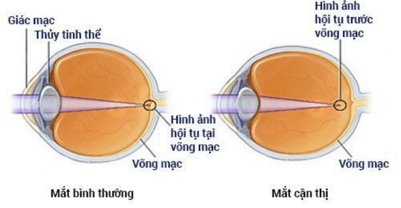 Trục loạn thị có ảnh hưởng gì đến mắt