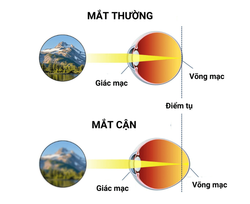 Người bị cận thị chỉ có thể nhìn rõ các vật ở gần trong khi khó nhìn rõ các vật ở xa