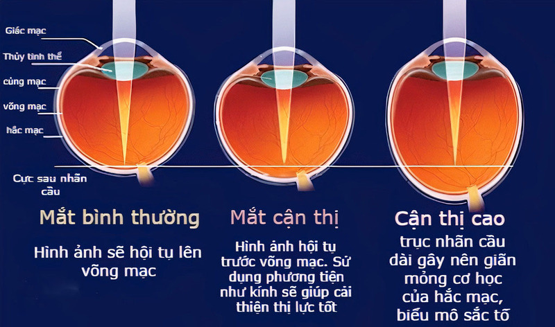 Cận thị là tật khúc xạ nhìn rõ các vật ở gần nhưng lại nhìn mờ các vật ở xa