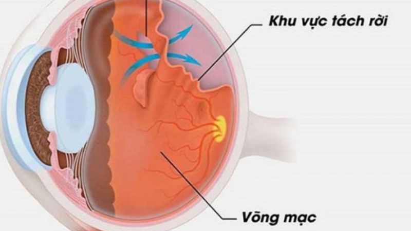 Thoái hóa võng mạc cận thị