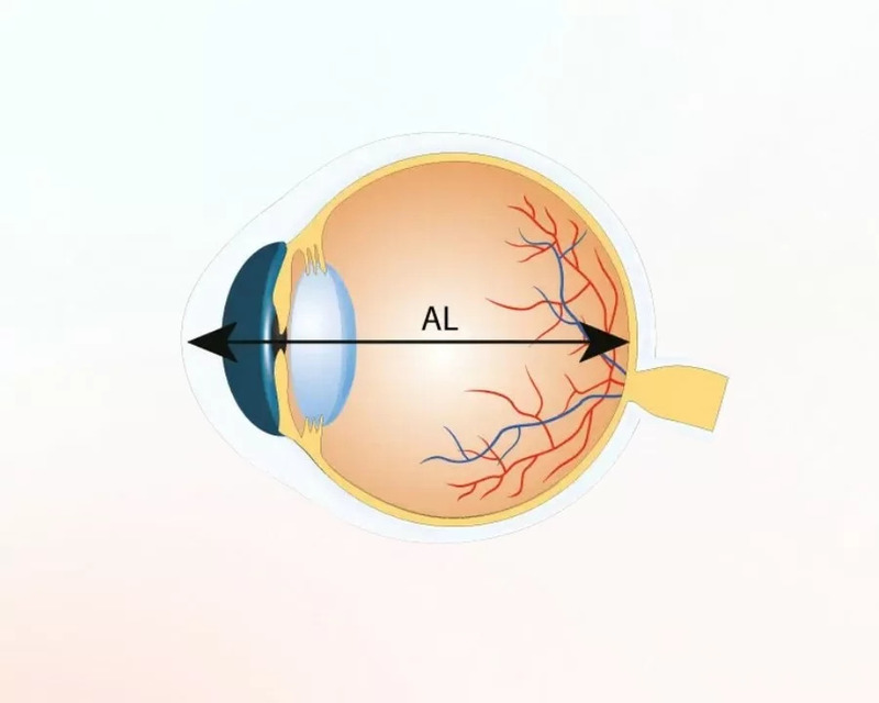 Mối liên hệ giữa độ dài trục nhãn cầu và sự phát triển thị giác