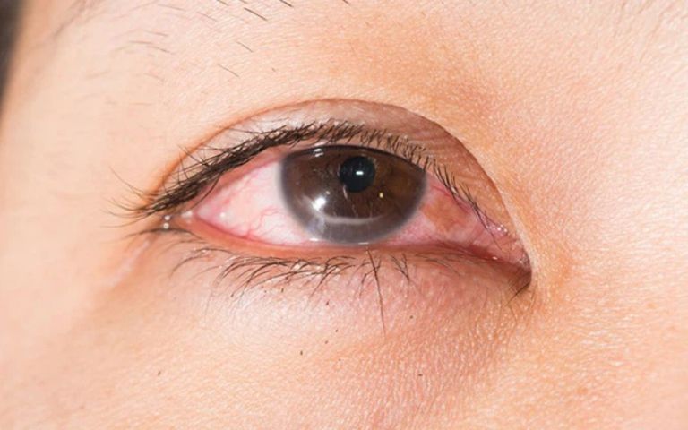 Thị lực giảm sau mổ cận thị