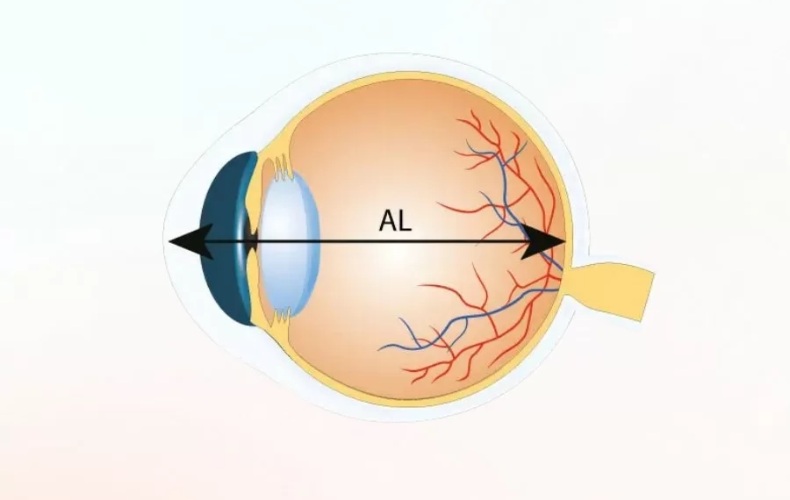 Trục nhãn cầu là khoảng cách giữa giác mạc ở phía trước mắt và điểm sau cùng của võng mạc